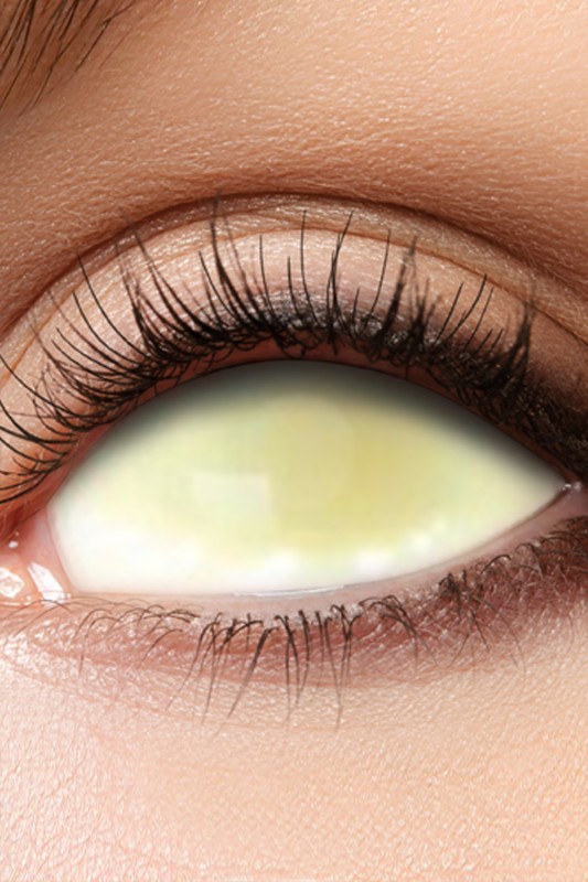 6-maandslenzen Sclera yellow eye